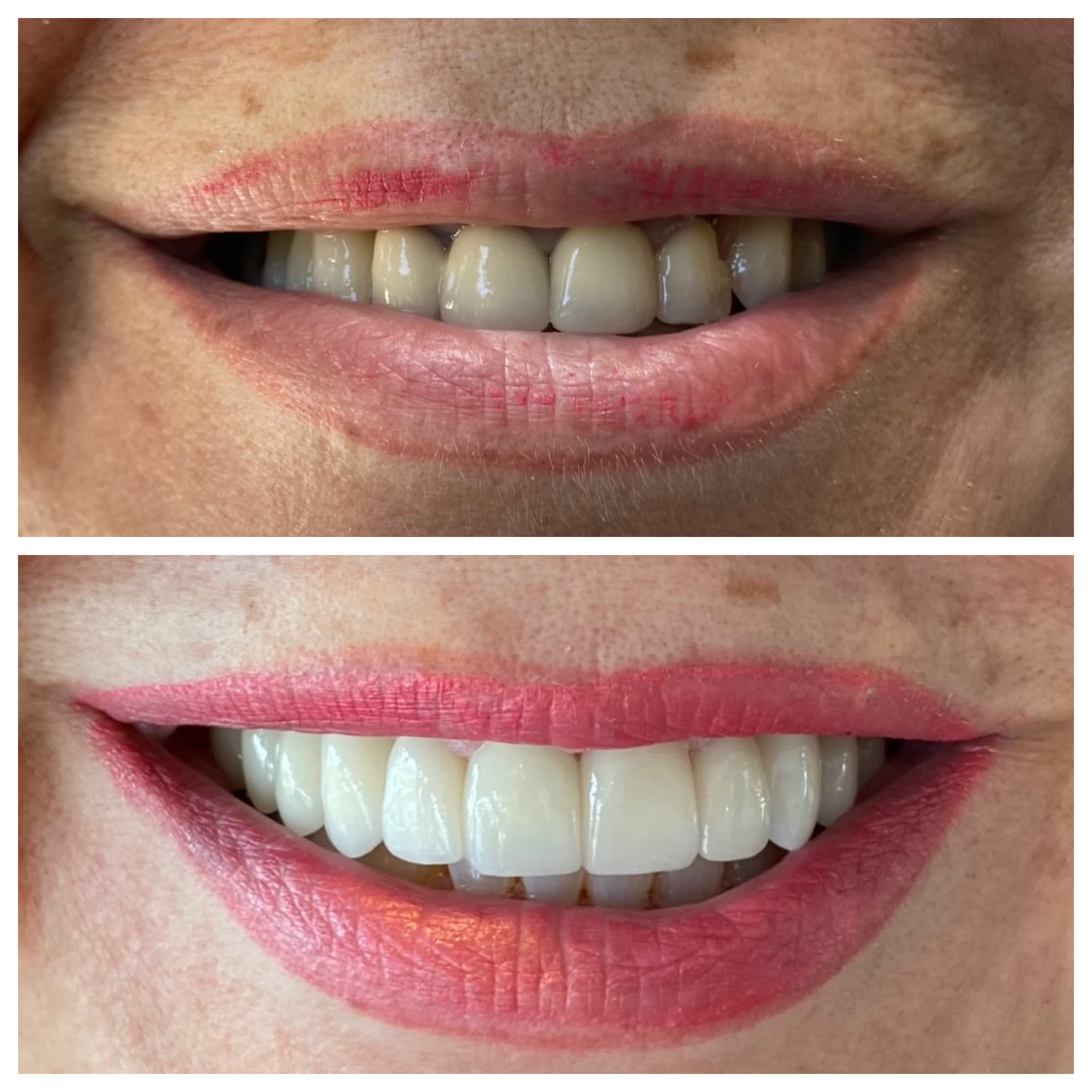 Smile transformation result from Beverly Hills periodontal practice