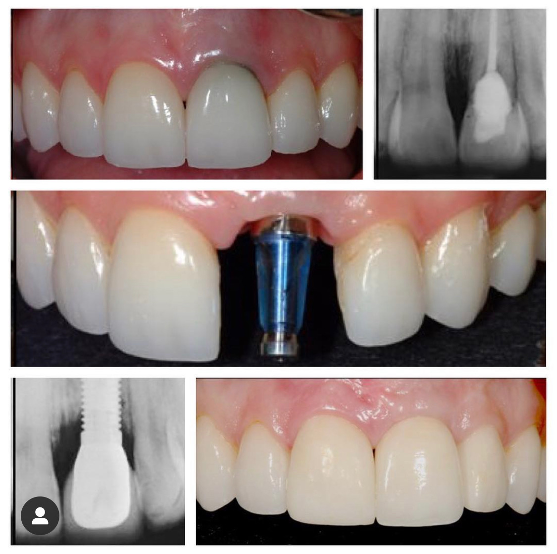 Dental implants — Beverly Hills
