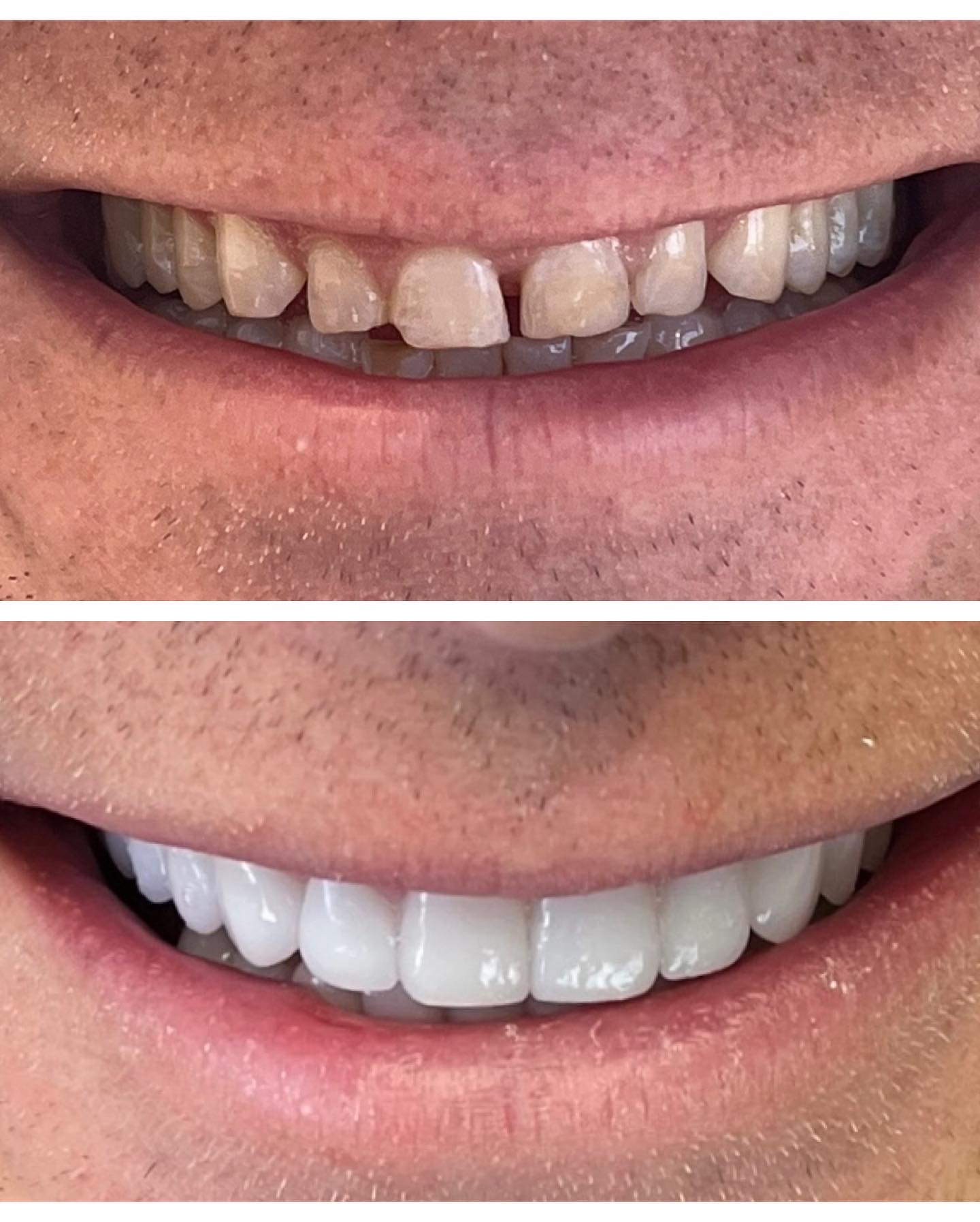 Smile transformation — Beverly Hills