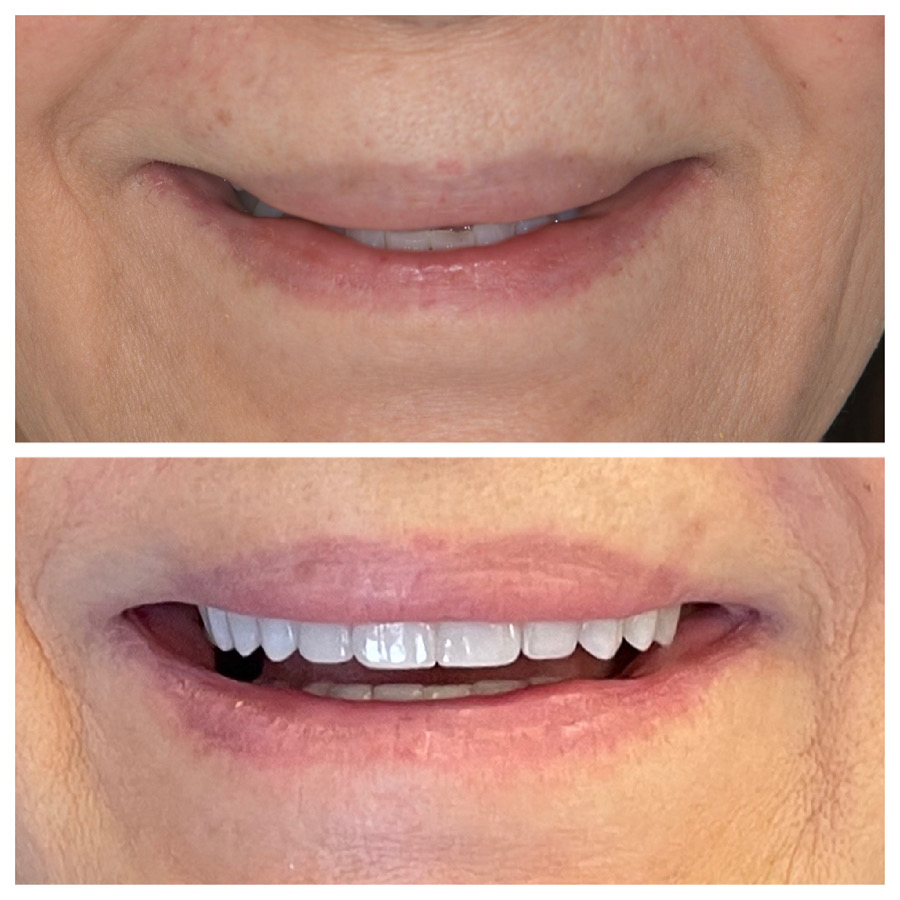 Smile transformation — Beverly Hills
