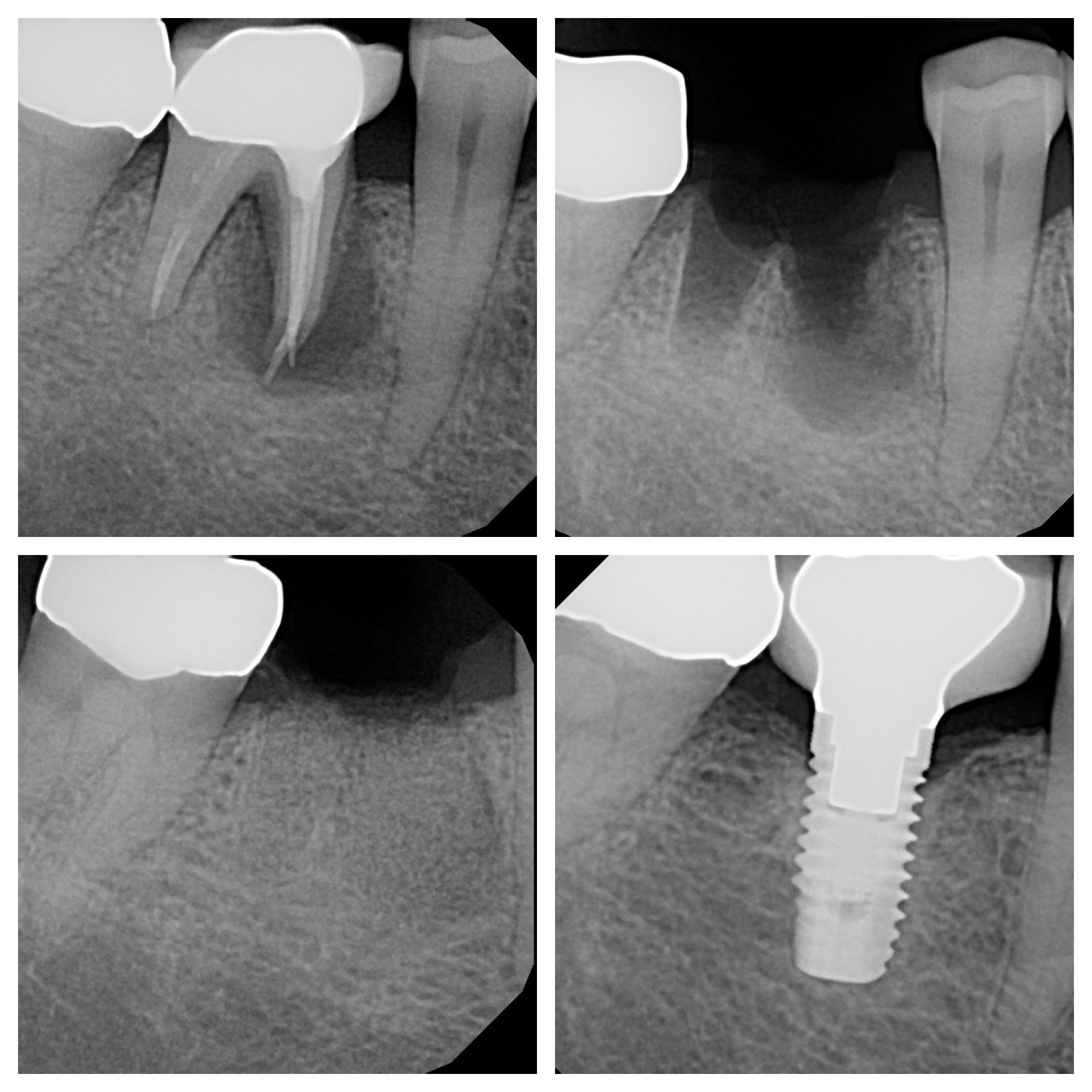 Implant X-rays
