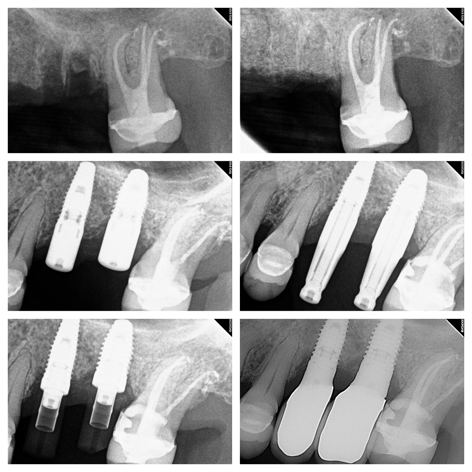Implant treatment