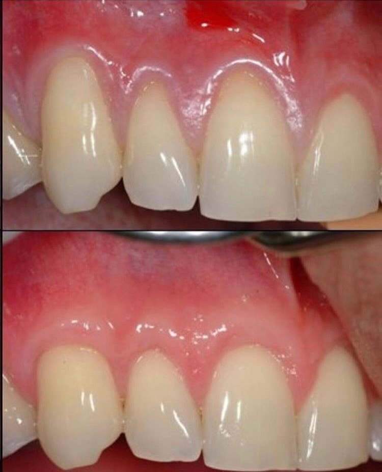 Gum tissue graft — Beverly Hills