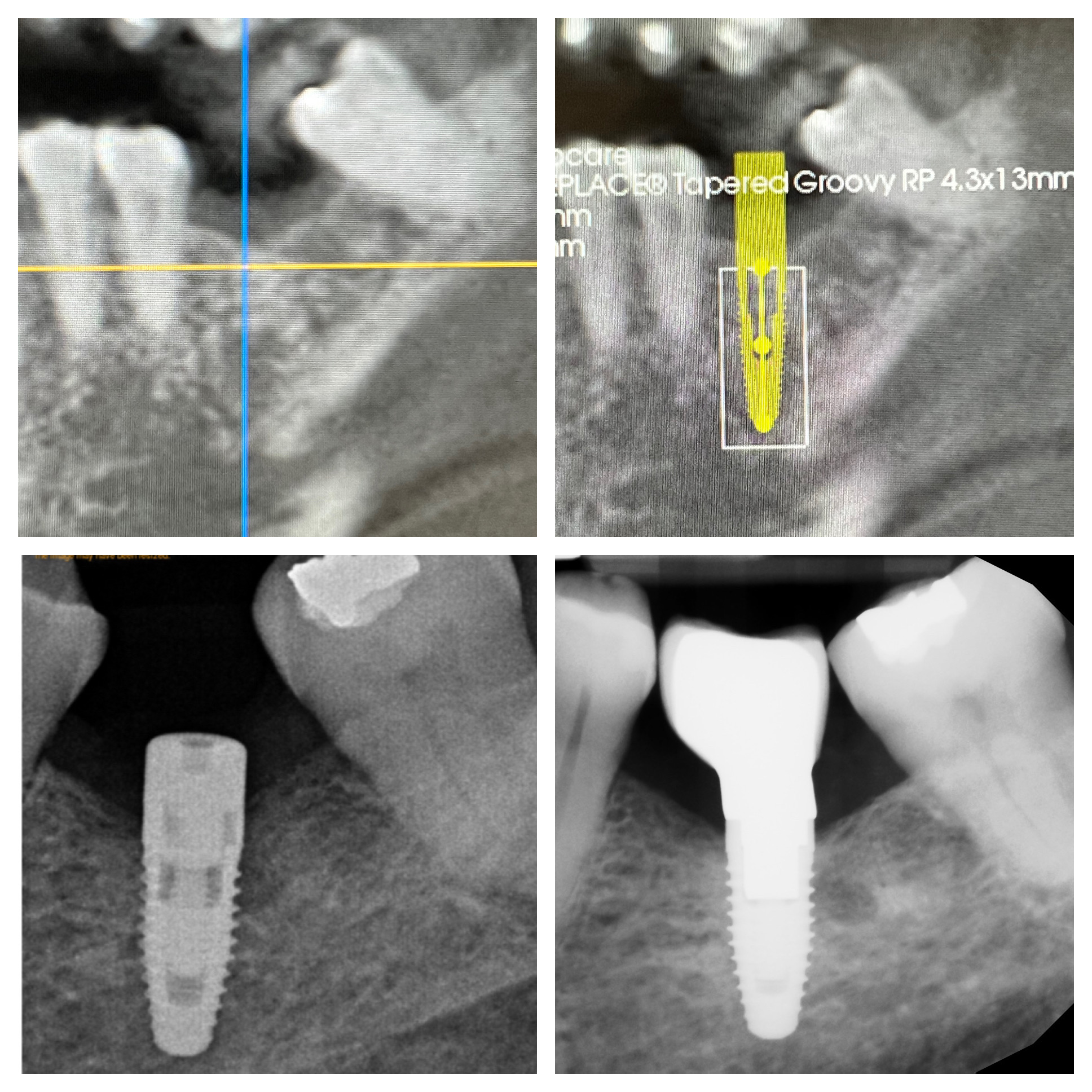 Implant CT planning